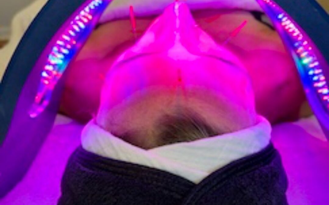 ENHANCED FACIAL REJUVENATION ACUPUNCTURE