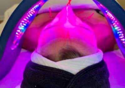 ENHANCED FACIAL REJUVENATION ACUPUNCTURE