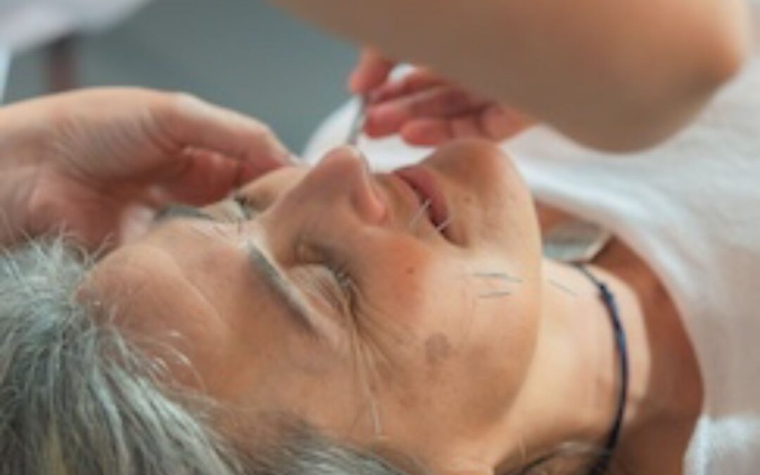STANDARD FACIAL REJUVENATION ACUPUNCTURE