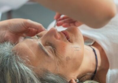 STANDARD FACIAL REJUVENATION ACUPUNCTURE